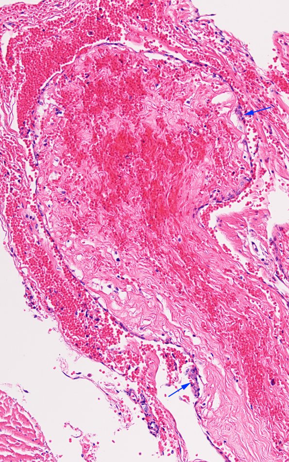 12A3 MVA (Case 12) N15 Arachnoid granulations 20X copy