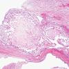 13A2 Superior Saggital Sinus and Arachnoid Granulations (Case 13) N15 H&E 2