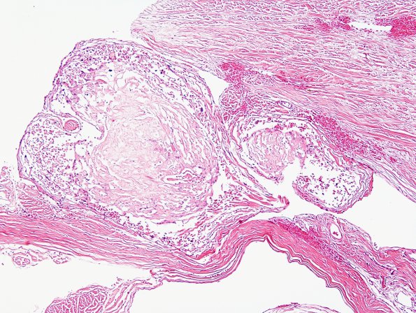 13A2 Superior Saggital Sinus and Arachnoid Granulations (Case 13) N15 H&E 2