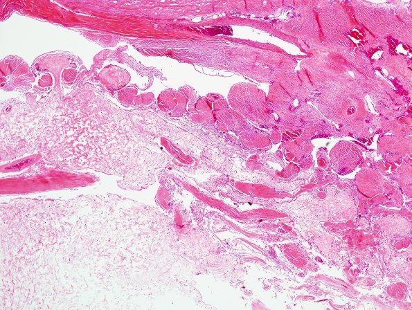 14 Arachnoid granulations in SSS (Case 14) H&E 1