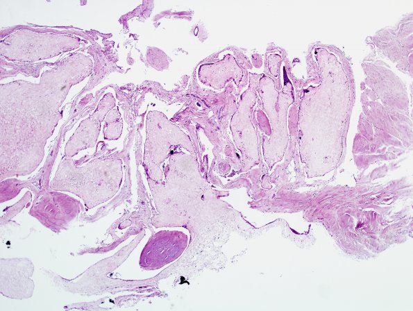 15A1 Arachnoid granulations (Case 15) H&E 1