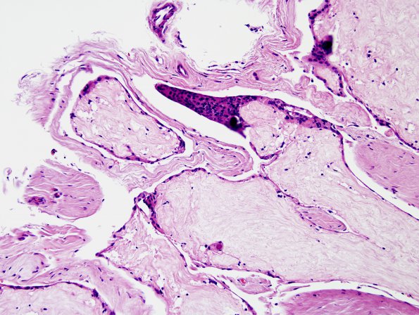 15A2 Arachnoid granulations (Case 15) H&E 2