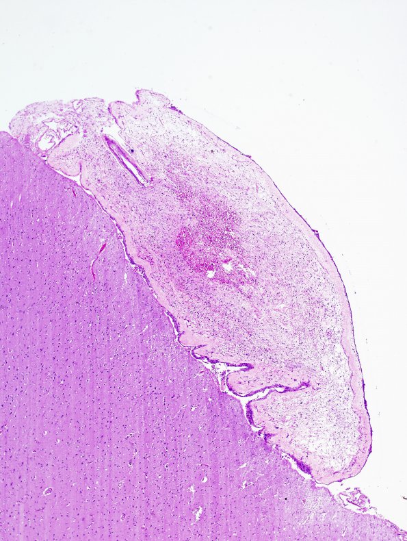 16A2 Arachnoid granulations (Case 16) H&E 1