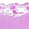 17 Arachnoid cap cells (Case 17) H&E 1