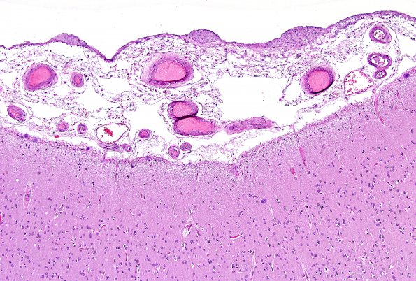 17 Arachnoid cap cells (Case 17) H&E 1