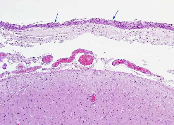 18 Arachnoid cap cells (Case 18) H&E 1 copy