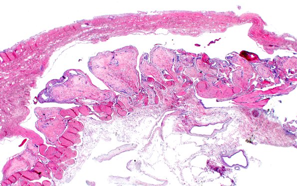 19A1 Arachnoid granulations (Case 19) H&E 2X