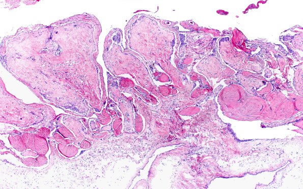 19A2 Arachnoid granulations (Case 19) H&E 4X