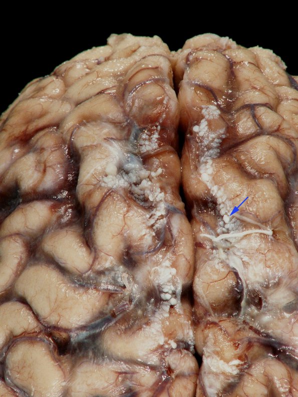 1A1 Arachnoid Granulations (Case 1) gross copy