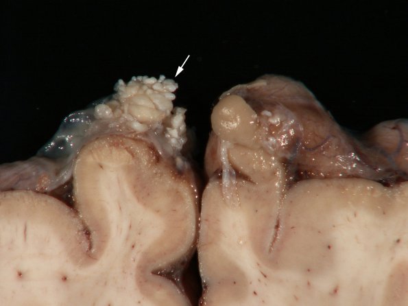 5 Arachnoid Granulations (Case 5) copy