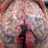 7 Arachnoid granulations (Case 7) Gross 1 copy