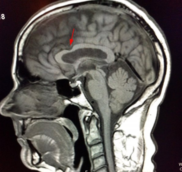 1B  Callosum defect-question artifact (Case 6) 1 copy