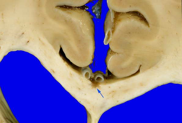 3A1 Callosum defect-question artifact (Case 3) 1 copyA