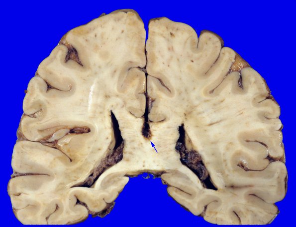 4A1 Callosum defect-question artifact (Case 4) SST & TV thrombi copyA