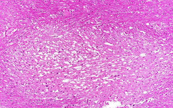 4B Callosum defect-question artifact (Case 4) SST & TV thrombi copy