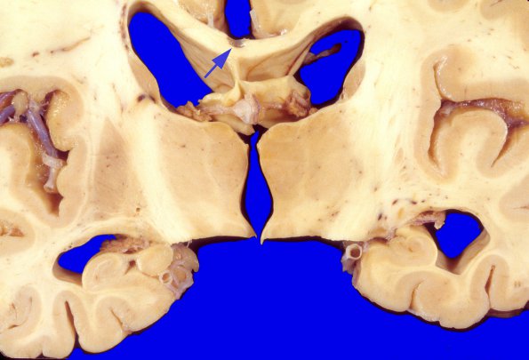 5A1 Callosum defect-question artifact (Case 5) 1A