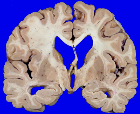 5A2 Callosum defect-possible artifact (Case 5) copyA