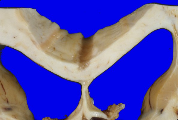 5A3 Callosum defect-artifact (Case 5) 1A