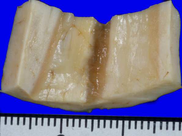 5A4 Callosum defect-questionartifact (Case 5) 2A