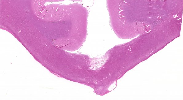 5B1 Callosum defect (Case 5) 1 attenuated