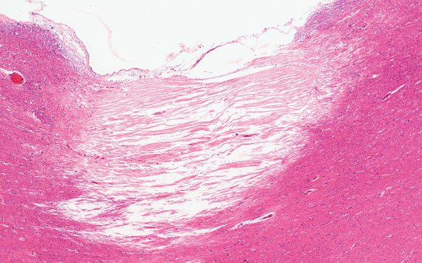 5B2 Callosum defect- (Case 5) H&E 2