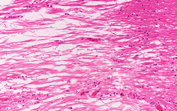 5B3 Callosum defect-(Case 5) H&E 1