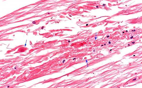 5B4 Callosum defect-artifact (Case 5) H&E 5 copy