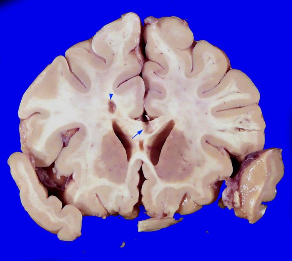 6A1 (Case 6) N13 Gross _1A copy AA