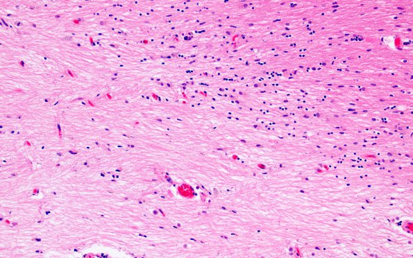 7B3 Notch mimic (MS plaque) H&E 20X 1