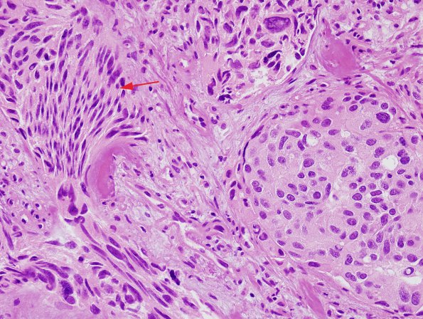 1A1 Artifact, crush-cautery, metastatic medullary thyroid cancer (Case 1) H&E 3