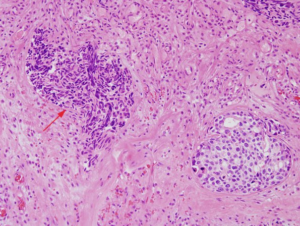 1A2 Artifact, crush-cautery, metastatic medullary thyroid cancer (Case 1) H&E 4