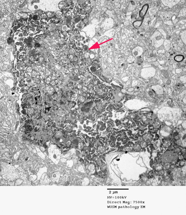 14A1 Artifact - Dark Cell Change cerebral cortex (Case 2) EM 006