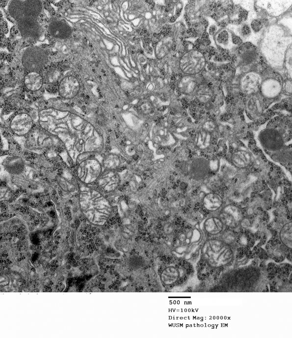 14A2 Artifact - Dark Cell Change cerebral cortex (Case 2) EM 007