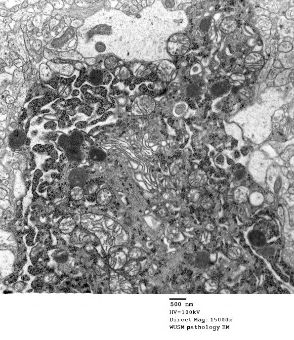 14A3 Artifact - Dark Cell Change cerebral cortex (Case 2) EM 008 - Copy