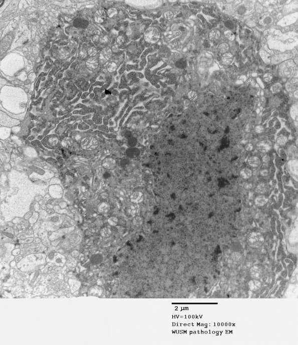 14A4 Artifact - Dark Cell Change cerebral cortex (Case 2) EM 010 - Copy