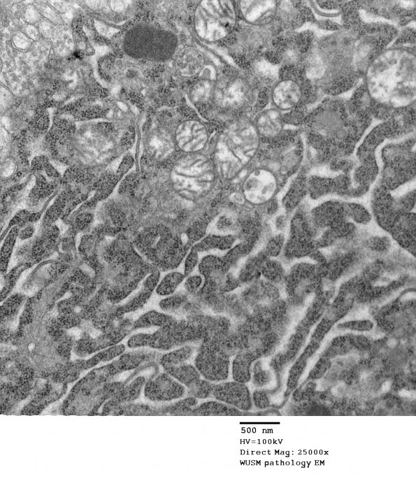 14A5 Artifact - Dark Cell Change cerebral cortex (Case 2) EM 012