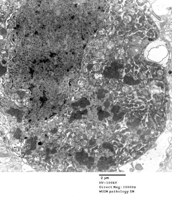 14A6 Artifact - Dark Cell Change cerebral cortex (Case 2) EM 014