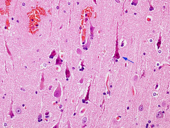 2 Artifact - Dark Cell Change (Case 6) H&E 2