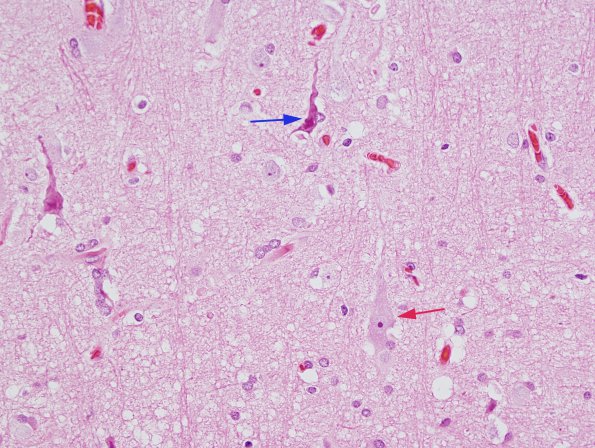 3 Artifact - Dark Cell Change (Case 7) H&E 1