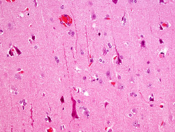 4 Artifact - Dark Cell Change (Case 11) H&E