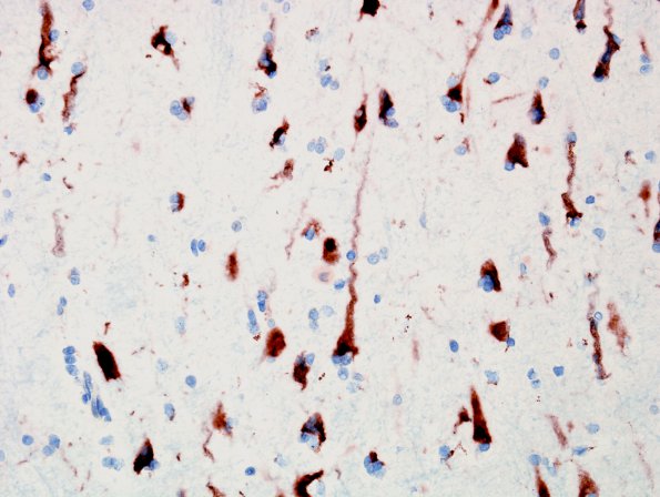 7 Artifact - Dark Cell Change 1A (Case 8) NeuN 2