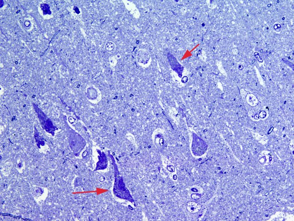 8A1 Artifact - Dark Cell Change (Cerebral cortex, Case 1) Plastic 7