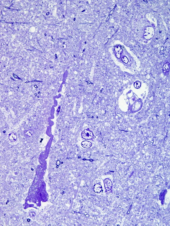 8A2 Artifact - Dark Cell Change (Cerebral cortex, Case 1) Plastic 8