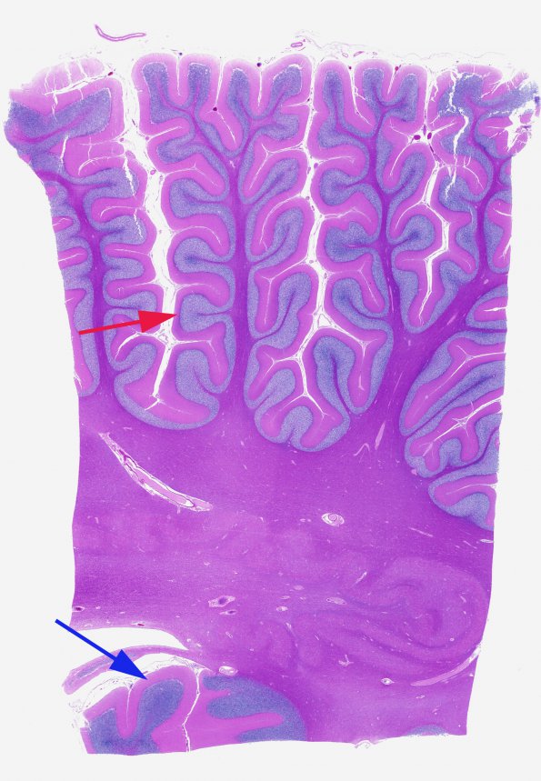 1B1 Artifact, autolysis, Etat Glace (Case 8) N9 H&E whole mount (2 areas)