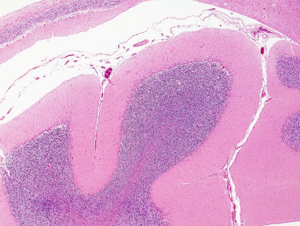 1B3 Artifact, autolysis, Etat Glace (Case 8) N9 H&E Area 2