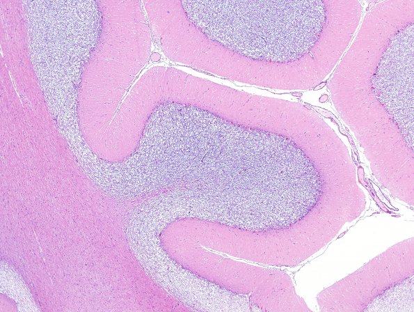 2B1 Artifact, autolysis, Etat Glace (Case 7) H&E 1