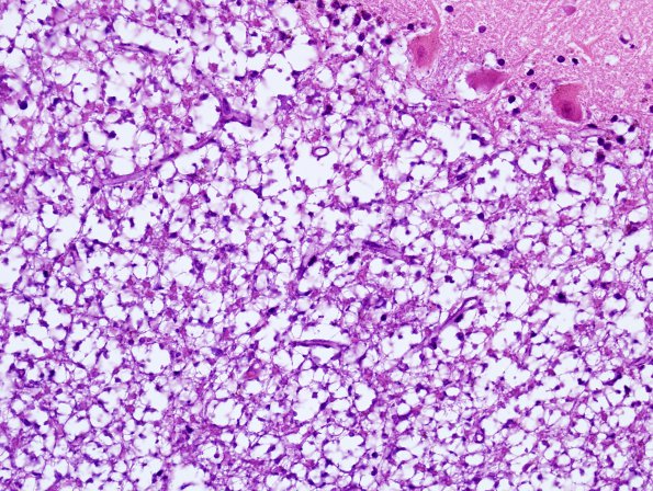 2B2 Artifact, autolysis, Etat Glace (Case 7) H&E 3