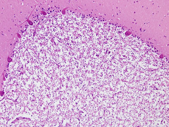 3A3 Artifact, autolysis, Etat Glace (Case 4) H&E 4