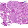 4 Artifact, autolysis, Etat Glace (Case 1) H&E 1 whole mount