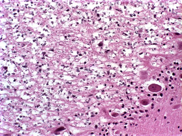 6A2 Artifact, autolysis, Etat Glace (Case 14) H&E 2